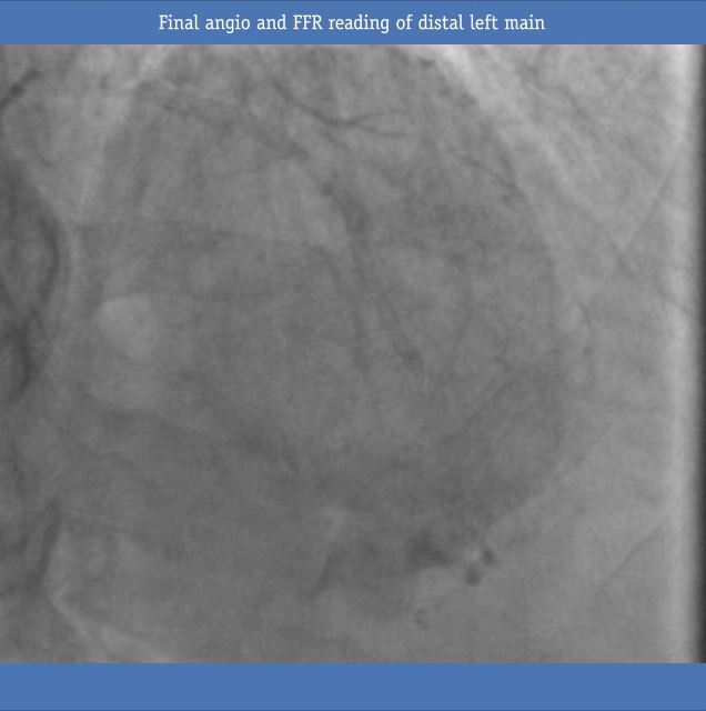 Final angio reading of distal left main